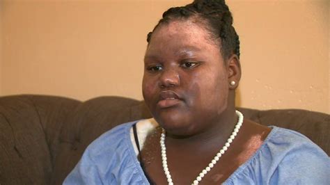 11 Year Old Girl Burned By Boiling Water During Sleepover I Cant Be Angry
