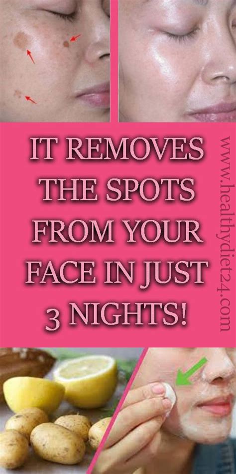 It Removes The Spots From Your Face In Just 3 Nights Spots On Face