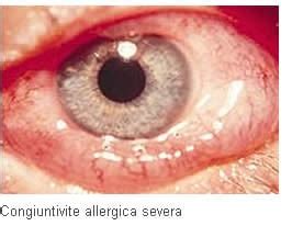 Alcune reazioni allergiche, definite reazioni anafilattiche, sono potenzialmente letali. Congiuntivite Allergica: Cause e Sintomi