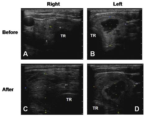 Full Text Acute Thyroid Swelling After Fine Needle Aspiration Biopsy