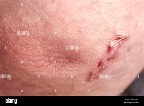 Dissolving Stitches Hi Res Stock Photography And Images Alamy