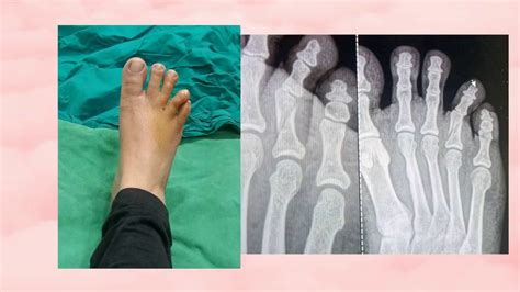 Fracture Of Toe Orthopedic Technique To Reduce The Traumatic Displaced