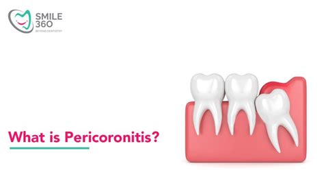 Pericoronitis Treatment Causes And Prevention Smile 360
