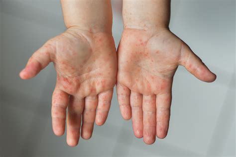 Hand Foot And Mouth Disease Hfmd In Children A Comprehensive Guide