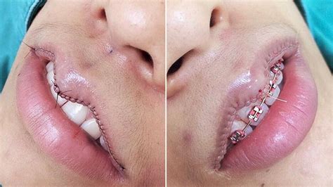 Lip Reduction Is the New Plastic Surgery Trend | Allure