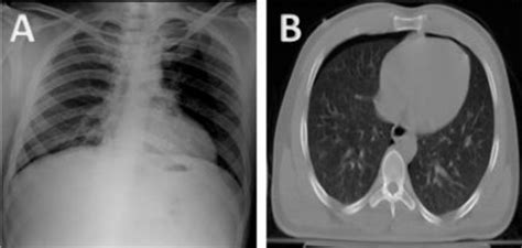 What are your imaging modalities for stroke? Anteroposterior chest radiograph vs. chest CT scan in ...
