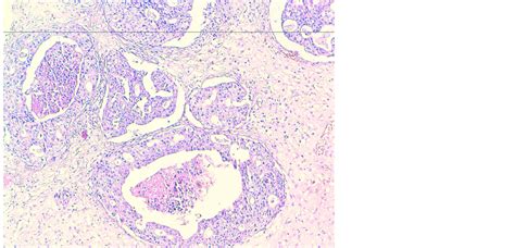 Cribriform Adenocarcinoma Salivary Gland Type Of The Nasopharynx Case Report And Review Of The