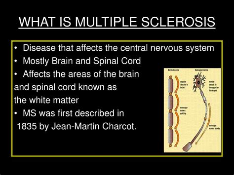 Ppt Multiple Sclerosis Powerpoint Presentation Id677271