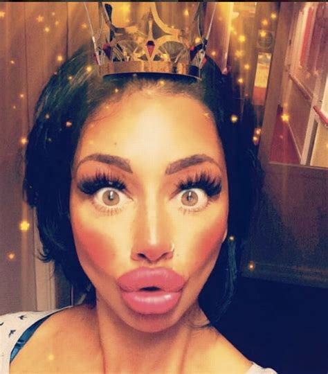 Single Mum Addicted To Lip Fillers Splashes Out More Than £1600 On Her
