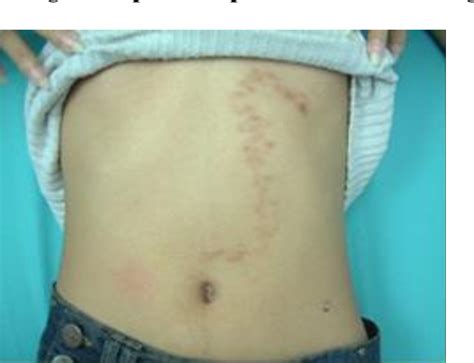 Figure 1 From Hookworm Related Cutaneous Larva Migrans In Traveler With