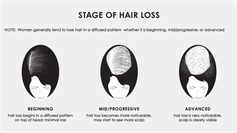 Stages Of Hair Loss Jon Renau Collection
