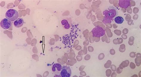 Cureus Visceral Leishmaniasis In A Non Endemic Region Of Eritrea
