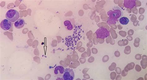 Leishmaniasis World Map