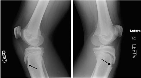 Figure 2 From Bilateral Tibial Tubercle Avulsion Fractures A Pediatric
