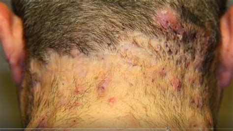 Hidradenitis Suppurativa Back Neck And Nose Pimples And Whitehead
