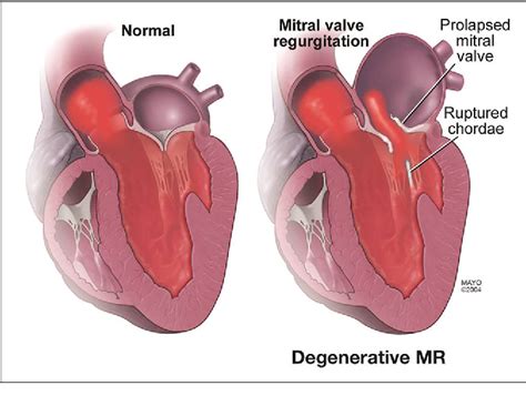 Figure 1 From Percutaneous And Minimally Invasive Approaches To Mitral