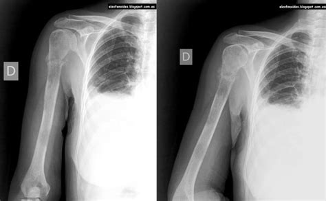 Radiografía del brazo frente Fractura cuello quirúrgico del húmero Quirurgico Fracturas