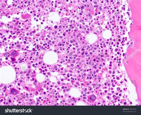 How to treat cancer in cats? Microscopic View Of Bone Marrow Biopsy From ...