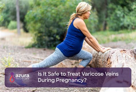 Treating Varicose Veins During Pregnancy Is It Safe