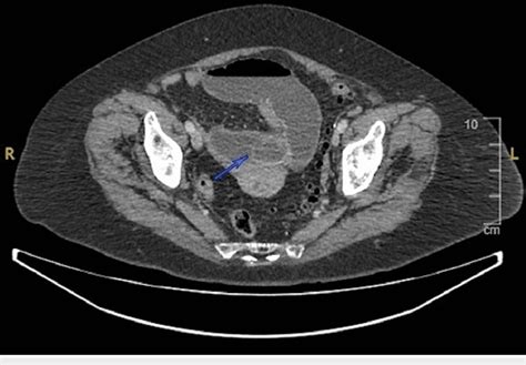 Computed Tomography Scan Axial View Of Abdomen Showing Obstructive
