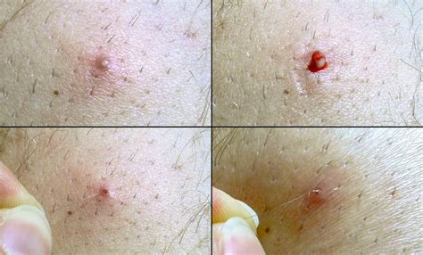 28 Ingrown Hair On C Section Scar Macfionn