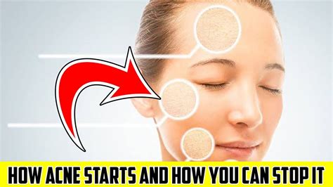 How Acne Starts And How You Can Stop It Loan Nguyen Acne Treatment
