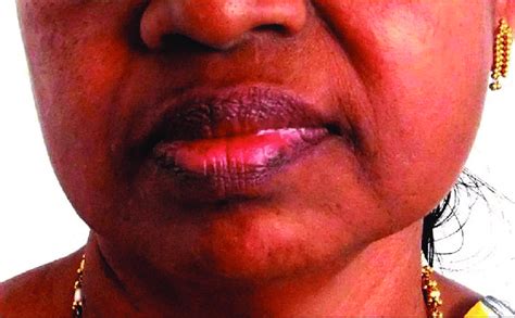 Extra Oral Photograph A Swelling In The Left Side Of The Face Causing