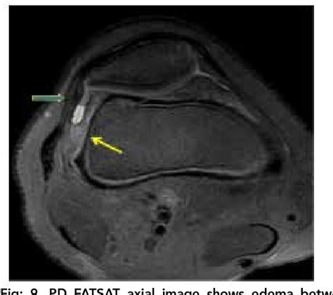 Table 1 From Fat Pad Impingement Syndromes Of Knee Under Diagnosed