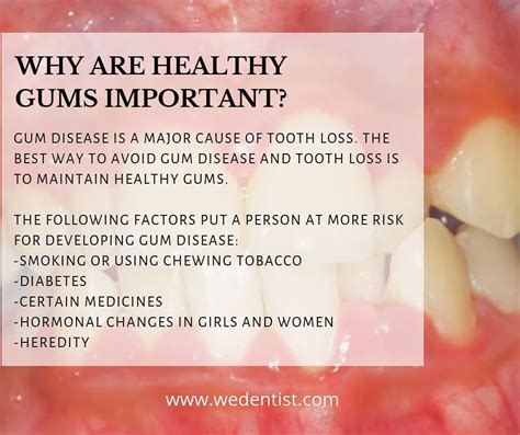 Why Are Healthy Gums Important Cosmetic Dentistry Dentistry