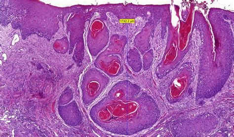 Histopathological Slide Of An Oral Squamous Cell Carcinoma Showing Download Scientific Diagram