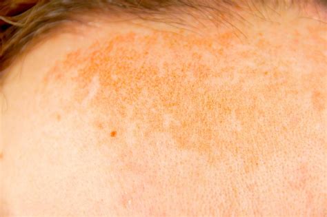 Hyperpigmentation Treatment Types And Causes