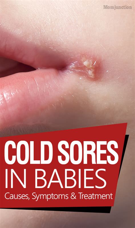 Cold Sores In Babies Causes Symptoms And Treatment