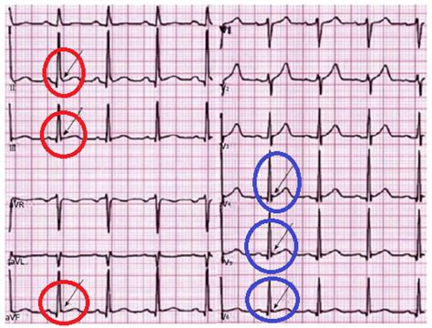 ECG Repolarización Precoz MonKeyEM