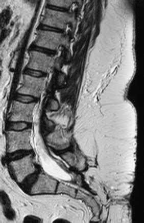 An l5 s1 disc herniation can be incredibly painful and uncomfortable. Disc displacement patterns in lumbar anterior spondylolisthesis: Contribution to foraminal ...