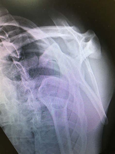 Shoulder Instability | Dr Doron Sher