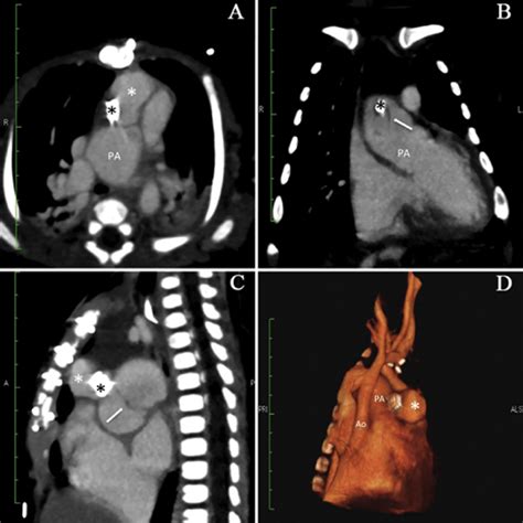 Computed Tomography Scan Of The Chest A An Axial Scan Shows Marked