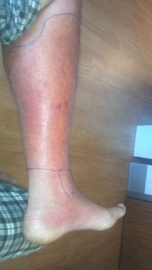 Early signs of cellulitis, a bacterial skin infection, include swelling and redness that come on quickly. Cellulitis - WikEM