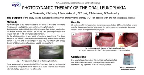 Pdf Photodynamic Therapy Of The Oral Leukoplakia