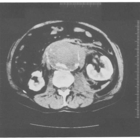 Contrast Enhanced Ct Scan Of Abdomen Demonstrates Large Calcific