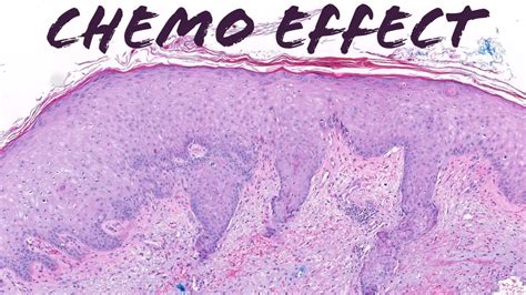 Chemo Rash Toxic Erythema Of Chemotherapychemo Effectepidermal