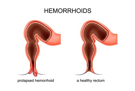Hemorrhoids Definition Types Causes And Symptoms Fresh Online News