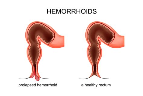 Difference Between Piles And Fissures Gastro Liver Care