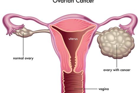 An Aspirin A Day Could Slash Womans Ovarian Cancer Risk Study