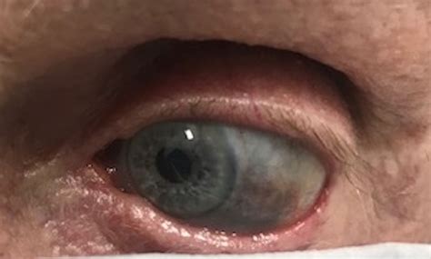 Minocycline Induced Blue Sclera And Skin Hyperpigmentation Bmj Case