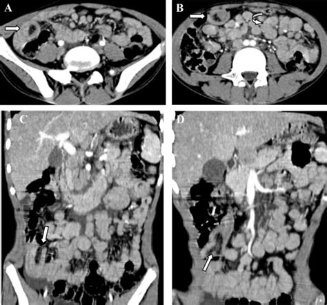 A B Axial Images And C D Coronal Contrast Enhanced CT Abdomen And