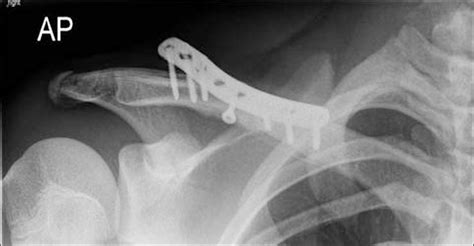 Is Removal Of Clavicle Plate After Fracture Union Necessary Abstract