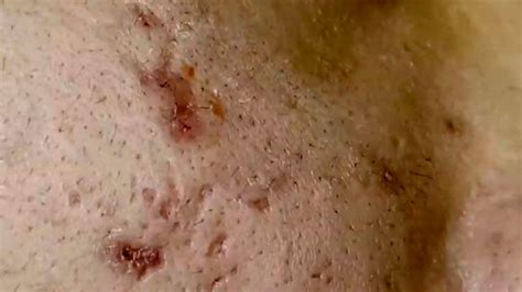 Blackheads And Pimples Removing Compilation Pimple Popping