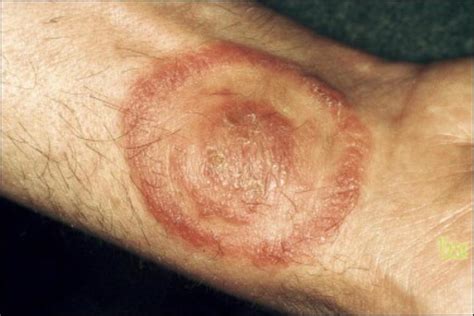 Dermatophytoses Causes And Treatment
