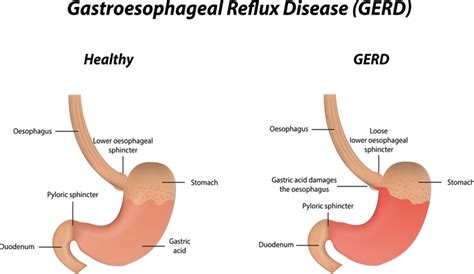 Gerd Causes Sign And Symptoms Homeopathic Treatment