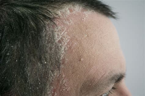 Psoriasis On The Hairline And On The Scalpclose Up Dermatological